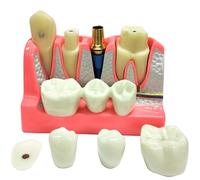 4 Times Dental Implant Model with Removable Crown Bridge Dental Veneers Porcelain Teeth for Stutent Study and Teaching Demonstration