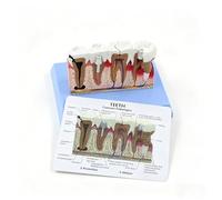 4-Tooth Dental Pathology Model with Carie Abscess Cracked Tooth Gum Disease
