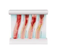 4Pieces Human Dynamic Vascular Model, Show Health to Illness Transition Blood Vessels, Vascular Dynamic Comparison Anatomy Model, for Medical Teaching Aid Science Study