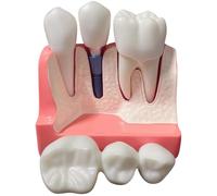 4X Enlarged Tooth Model, Dental Implant Model with Removable Crown and Gingiva, PVC Teeth Models for Patient Education, Visual Teaching Aid for Clinical Training