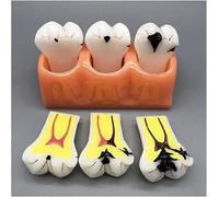 4X Large Teeth Model - Caries Pathologic Caries Model - Dental Teeth Model Shallow Caries Deep Caries Patient Demo Teaching Model