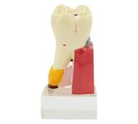 4X Magnified Dental Caries Anatomy Model with Non-Slip Base - Dental Education Tool for Demonstrating Caries Progression and Tooth Structure