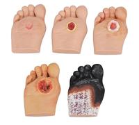 5 Pcs Diabetic Foot Care Model, Grade 1-5 Diabetic Foot Nursing Simulator Model,Purulent Wound Lesions Grade For Anatomy, Physiology, Wound Care Demonstrations Tool