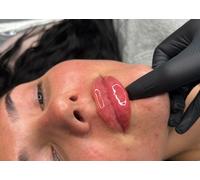 5ml precision filler for up to 5 areas with comprehensive consultation