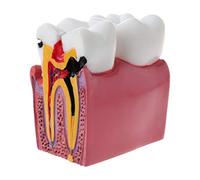 6 Caries Comparation Anatomy Teeth Model for Anatomy Lab Tea Skull Model for Kids