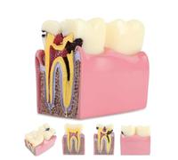 6 Times Decay Teeth Comparative Study Model(8 * 5 * 9 cm/5 * 6 * 3 INCH), Dental Caries Tooth Model, Caries Bilateral Comparison Pathology Teeth Model Teaching Learning Tools,A