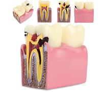 6 Times Decay Teeth Comparative Study Model Dental Caries Tooth Model Caries Bilateral Comparison Pathology Teeth Model Teaching Learning Tools