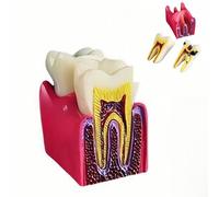 6 Times Dental Caries Model Teaching Typodont Tool for Dentists, Patients, Teachers and Students Studying and Researching (Teeth Removal)