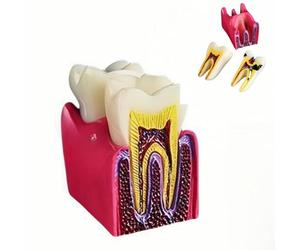 6 Times Dental Caries Model Teaching Typodont Tool for Dentists, Patients, Teachers and Students Studying and Researching (Teeth Removal)