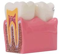 6X Dental Caries Cross Section Anatomy Model Tooth Model for Teach Study Practice Dental Medical Model Human Organ Mode