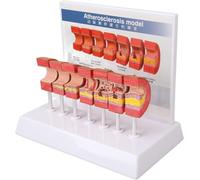 7PCS Artery Anatomy Model, Vascular Anatomical Model, Pathological Arteriovenous Amplification, Atherosclerosis Thrombosis Process Educational Tool.