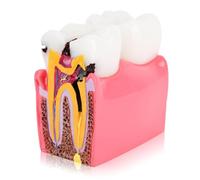 Agatige Dental Caries Teeth Model, 6 Times Enlarged Dental Anatomy Comparison Study Models Dentist Education Teeth Model Dental Caries Developing Model for Dental Studies & Research