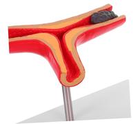 Alipis Detailed Blood Vessel Anatomical Model with Vascular Blockage Simulation for Medical Teaching Supplies Construction for Clinical Research and Educational Demonstrations