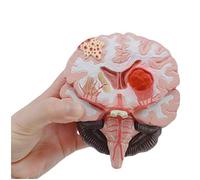 Anatomical Brain Model - Malformed Brain Pathological Structure Model - Cerebral Cortex Gray Matter Brain Stem Hemorrhage Arteriovenous Anatomy Model