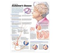 Anatomical Chart Understanding Alzheimer's Disease
