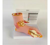 Anatomical Gout Model Left Foot for Education - Human Foot Model with Display Base and Annotation Card for Medical Training and Demonstration