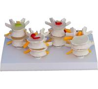 Anatomical Lumbar Spine Model for Medical Education and Herniation Study