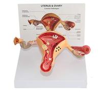 Anatomy model Anatomy Models, Human Pathological Uterus Ovary Model, Female Reproductive Organ, Anatomical Anatomy Disease Pathology, Medical Lesion for Teaching Learning Tool