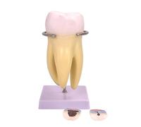 Anatomy Model Molar Tooth Anatomy with Detachable Parts Human Tooth for Diseases Study Teeth Removable for Patient Education with Numbers