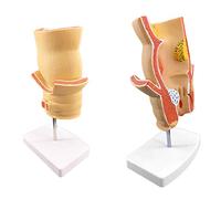 Anorectal Acne Model - Human Organ Anatomy Model Hemorrhoids Demonstration Model -Educational Model Rectal Model - for Medical TeachingAid,A