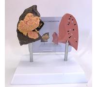 ATJOGWIN Human lung model that normal lungs and smoking lungs comparison model