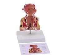 ATJSXWIN 1.5X Human Pathological Rectum Anatomical Model with Description Card and Display Base