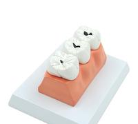 ATJSXWIN Dental Caries Anatomical Model, Detachable Tooth Model, Caries Pathological Model for Dental Medicine Teaching