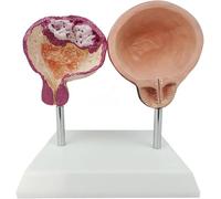 Bladder Anatomy Model, Healthy and Pathological Urology Teaching Tool, Male Abdominal Smoking Bladder Demonstration for Medical Education