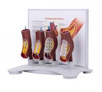 Blood Vessel Occlusion Model, Human Vascular Stent Model, Blood Vessel Enlargement Demonstration Model with Explanation Card, Real Representation and Durable, for Teaching, Demonstration