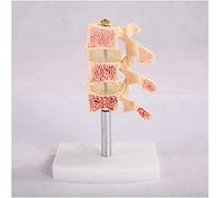 BODHIS Study Model Education Model Human Osteoporosis Model - Osteoporosis Joint Model Bone Model Medical