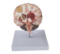 Bosiyrggrl Human Brain Disease Model - Brain Pathology Brainstem Hemorrhage Medical Teaching Model - Human Brain Anatomy Model