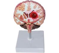 Brain Anatomical Model, Human Brain Anatomical Model,Stroke Model,Cerebral Hemorrhage Cerebral Arteriovenous Malformation Pathological Model