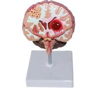 Brain Anatomical Model, Stroke Cerebral Hemorrhage Cerebral Arteriovenous Malformation Brain Pathology Teaching Models for Neurology Medical Teaching Aid.