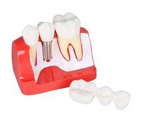 Bridge Implant Training Model with Removable Crown - Tooth Pathology Study Demo for Teaching & Research