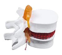 Buhdjfnke Human Anatomy Skeleton Spine Lumbar Disc Herniation Teaching Model Brain Skull Traumatic School Supplies Instrume
