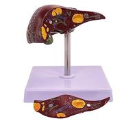 BuTkus Life Size Pathological Liver Anatomy Model, 2 Detachable Parts For Teaching Models Doctor-Patient Communication