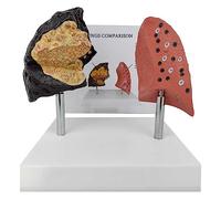 BuTkus Smokers Lung Model + Healthy Lung Model,with Pathological Features And Accurate Anatomy Structure For The Effects Of Smoking On Lung Health