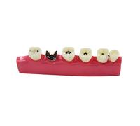 BYERZ Teeth Periodontal Disease Model Dental Caries Breakdown Display Periodontitis Show Teaching Tooth Model Dentistry Lab Products