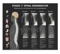 BYLSAGWHT Spinal Degeneration Level Chart Educational Anatomy Poster Vertebral Subluxation Demonstration Canvas Print Wall-Art for Home Office Decor(Framed,16x24inch(40x60cm))