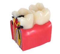 Cabilock Caries Tooth Decay Model for Education Comparative Anatomy Teaching Tool with Magnified Healthy Vs Decayed Teeth Display for Students Patients Clinics and Home Learning