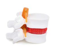 Calla Scorpio 1:1.5 Size Magnification Human Lumbar Spine Vertebrae Degenerative Disc Anatomical Model White