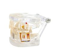 Clear Implant Teeth Model with Removable Teeth for Dentist Office Patient Communication Medical Lecture Use Models with Removable for Students Model Kit Wisdom Teaching Kids