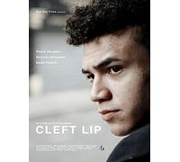 Cleft Lip