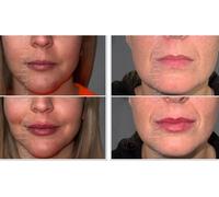 Clinical Dermal Filler with Consultation - 0.5 ml