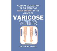 Clinical Evaluation of the Effect of Leech Therapy in the Cases of Varicose Veins