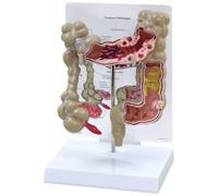 Colon Model for Anatomy Education, Life-Size Digestive System Replica, Pathology Teaching Tool, Human Colon Lesion Model for Science Classes