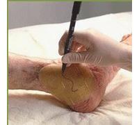 Coloplast Comfeel Plus Ulcer Dressing Sterile 6"X6" Hydrocolloid Dressing - Model 3115 by Coloplast