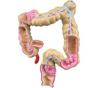 Colorectal Pathology Model, Gastrointestinal Model, Colorectal Lesion Model, Intestinal Disease Human Colorectal Lesion Model - Human Organ Anatomy Model Pathological Anatomical