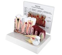 Common Pathologies Tooth Model, Caries Disease Teaching Aids, with Detachable Tooth, Teeth Cross-Section Display, Dental Gums Anatomical Model, for Education, Patient Communication
