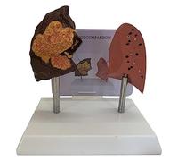 Comparative Model of Smoking Lungs,with Pathological Features and Accurate Anatomy Structure
